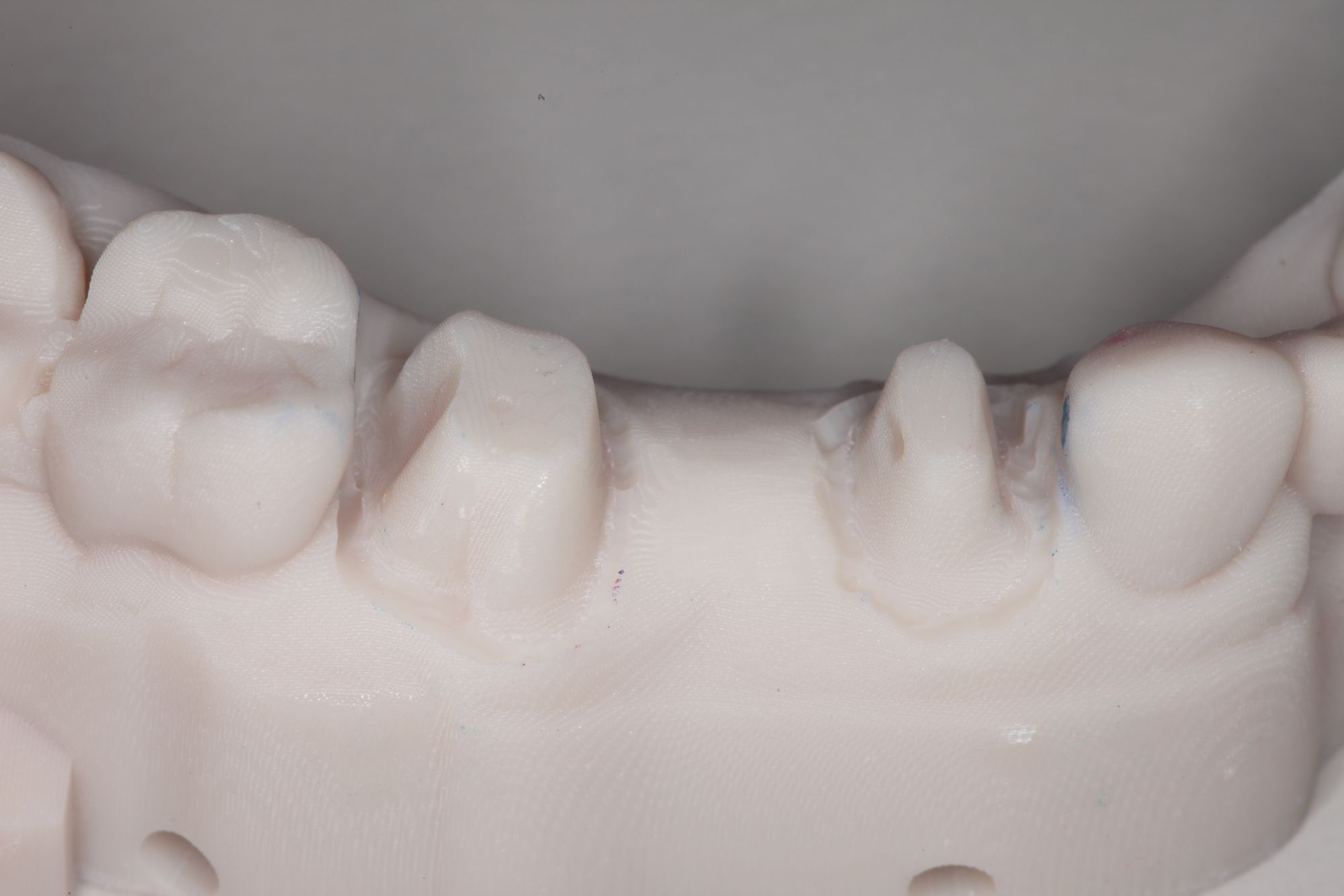 The ResinModified Glass Ionomer Cement Is Here